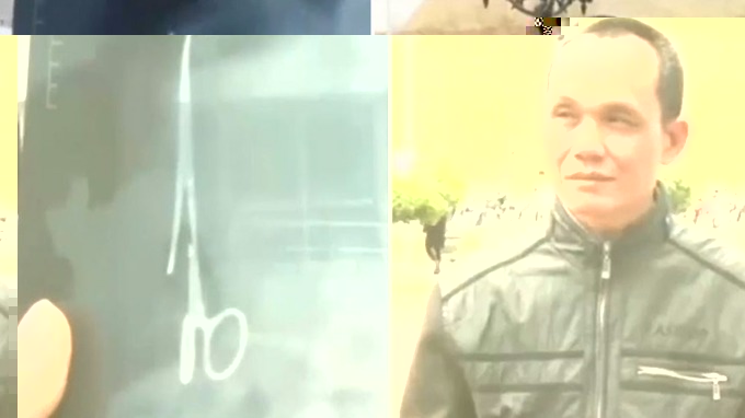 Scissors removed from man’s stomach 18 years after surgery