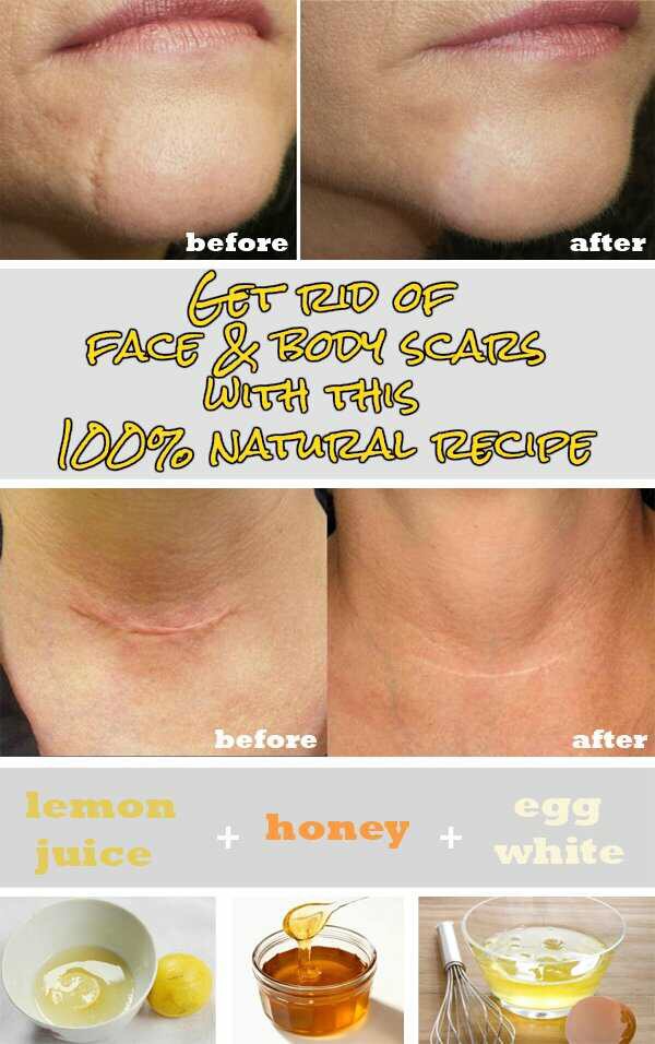 Get rid of face and body scars with this 100% natural recipe