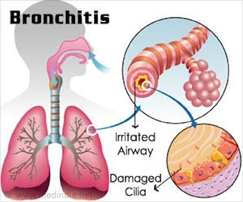 Home remedies for bronchitis