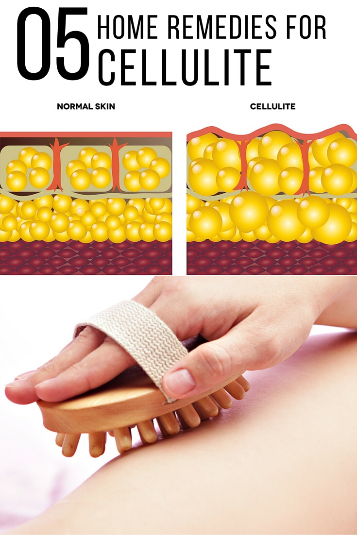 5 best home remedies for cellulite