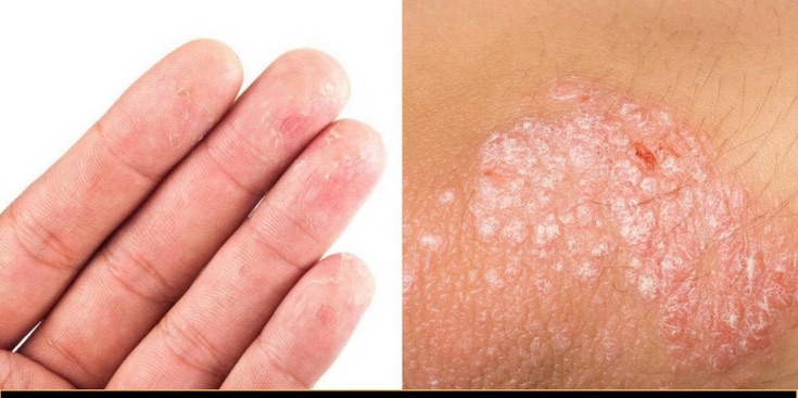 Best antiseptic ointment that treats eczema and psoriasis