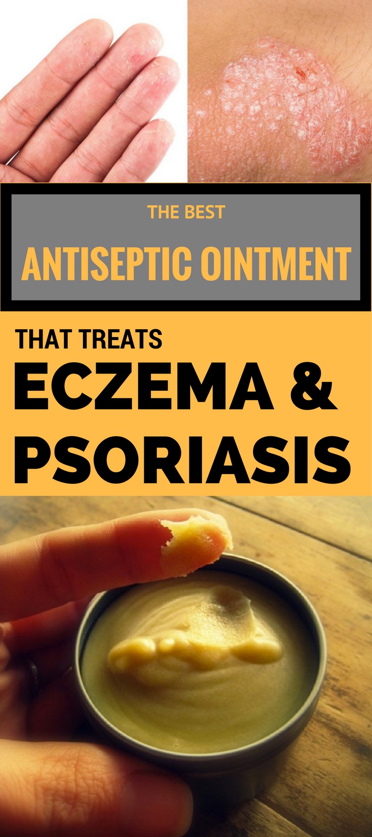 Best antiseptic ointment that treats eczema and psoriasis