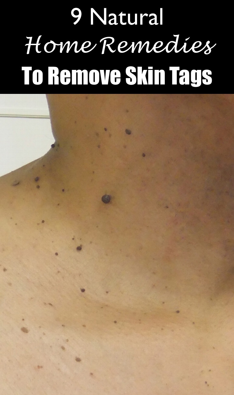 9 natural home remedies to remove skin tags
