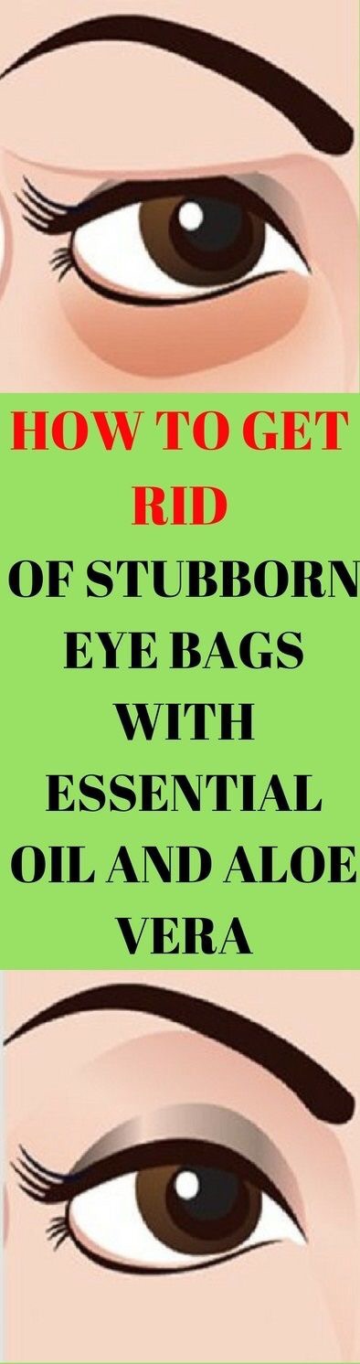 How to get rid of stubborn eye bags with essential oil and aloe vera