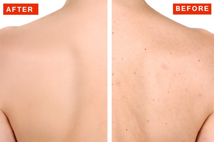 How to get rid of black acne fast naturally