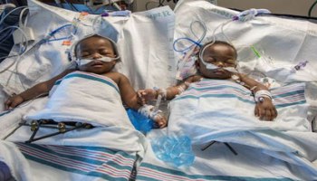 Health minister performs successful surgery on siamese twins