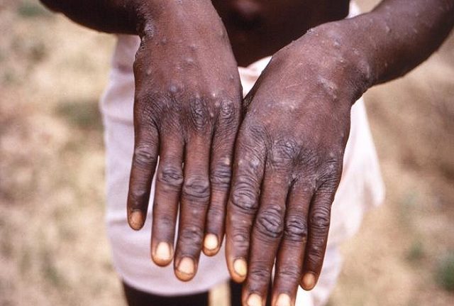 Monkeypox now in 11 states