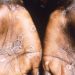 Monkeypox: How it spreads, who’s at risk – Here’s what you need to know